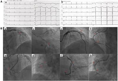 Case Report: A case report of myocardial fibrosis activation assessment after unstable angina using 68Ga-FAPI-04 PET/CT